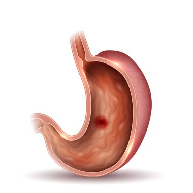 Mide ülseri, interanl organların anatomisi renkli çizim