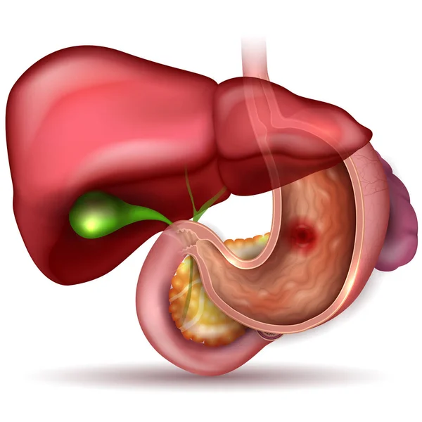 Язва желудка, анатомия межжелудочных органов красочный рисунок — стоковый вектор