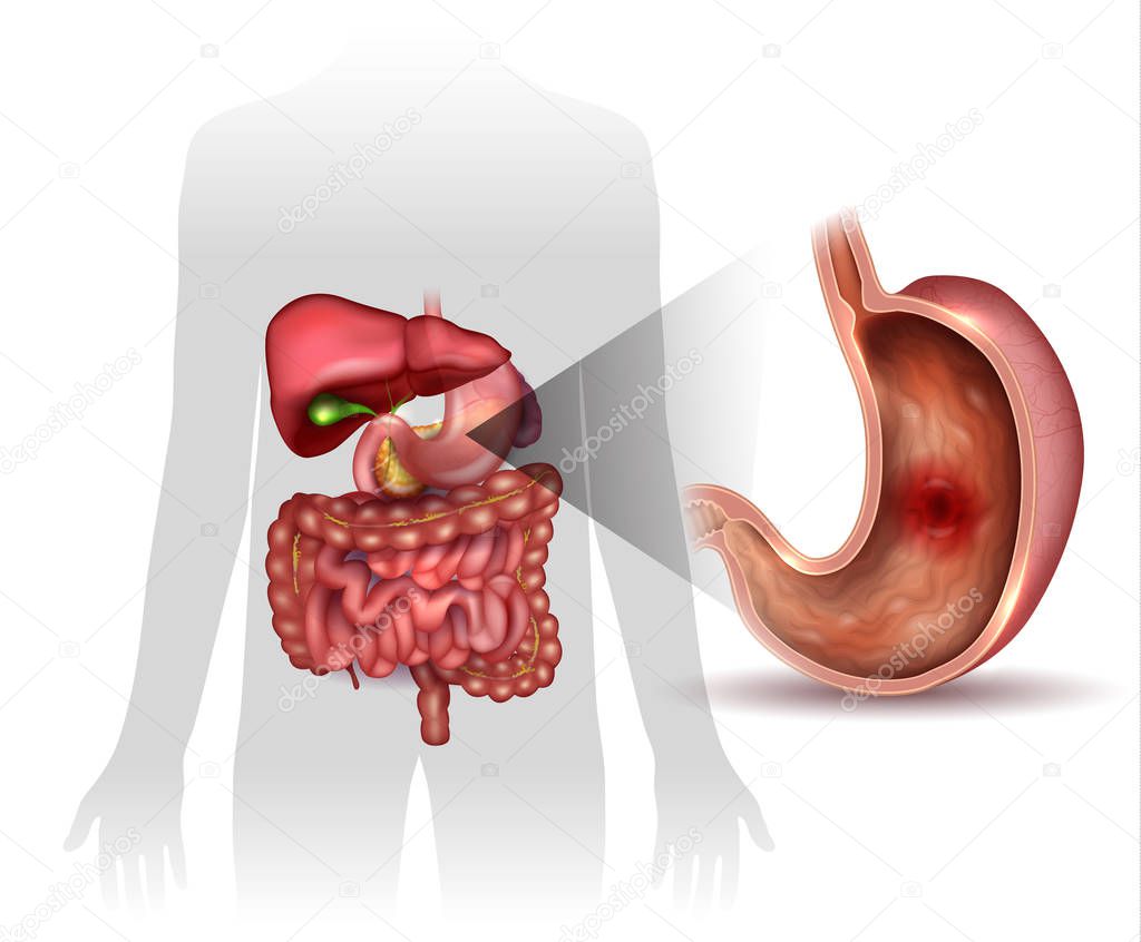 Stomach ulcer, interanal organs anatomy colorful drawing