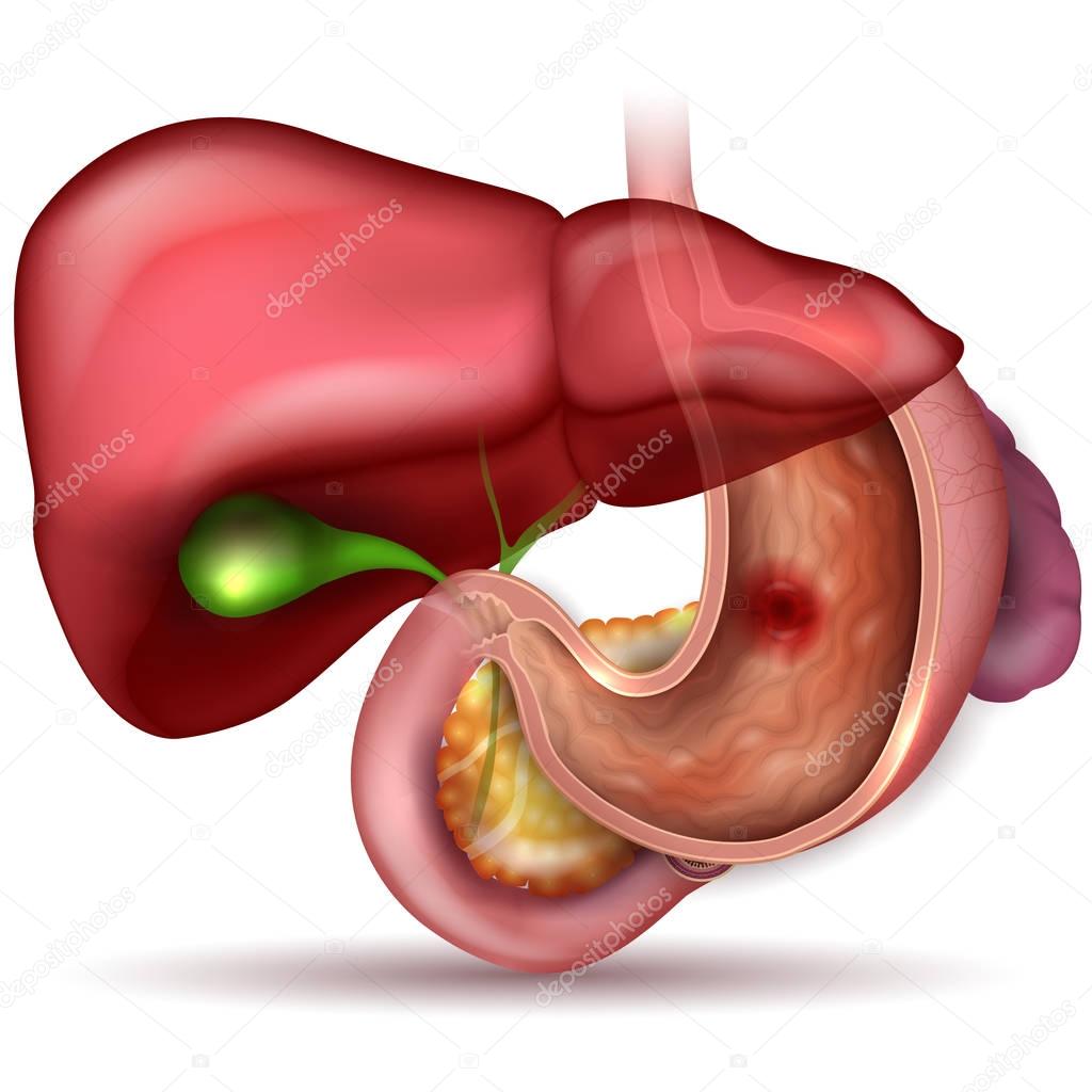 Stomach ulcer, interanl organs anatomy colorful drawing
