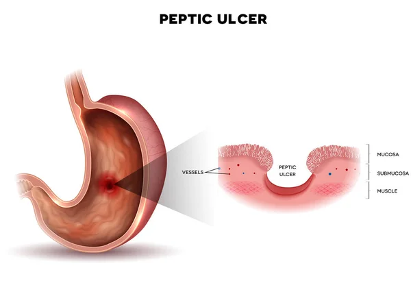 Пептична виразка шлунка, мікроскопічна барвиста анатомія — стоковий вектор