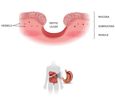 Peptic ulcer of the stomach on a white background, at the bottom clipart