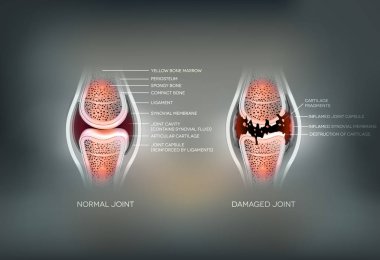 Damaged joint and normal joint colorful design  clipart