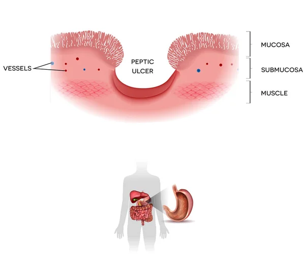 Úlcera péptica del estómago sobre un fondo blanco, en la parte inferior — Archivo Imágenes Vectoriales