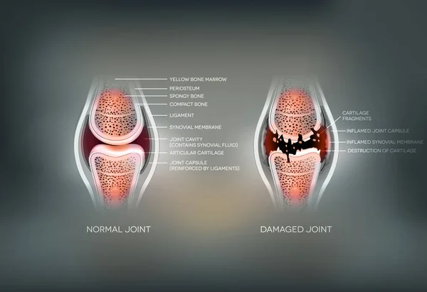 Damaged joint and normal joint colorful design — Stock Vector