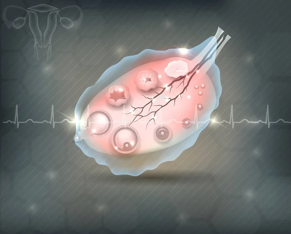 Konzept der weiblichen Eierstockstörung auf einem abstrakten grauen Netzhintergrund — Stockvektor