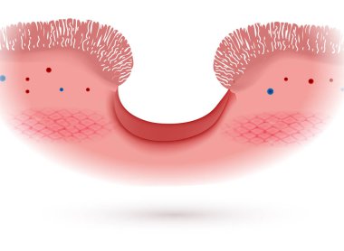 Peptic ulcer of the stomach  clipart