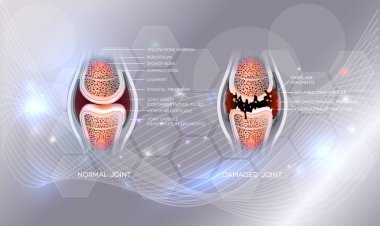 Hasarlı eklem ve normal eklem
