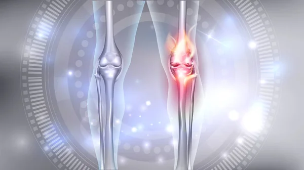 Problemi alle articolazioni del ginocchio — Vettoriale Stock