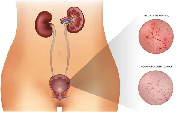 Inflammation of the urinary bladder and healthy lining — Stock Illustration Inflammation of the urinary bladder and healthy lining Royalty Free Stock Illustrations