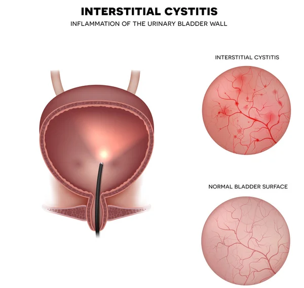 Urinary bladder lining — Stock Illustration Urinary bladder lining Stock Vector