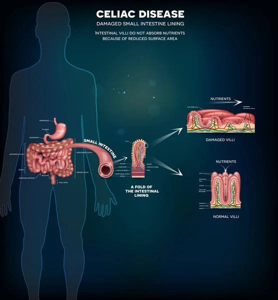 Celiaki info affisch — Stock vektor