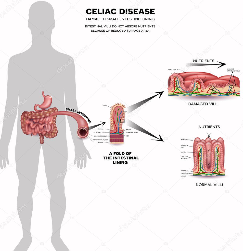 Celiac disease info poster