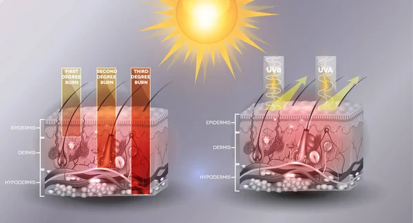 Anatomia da pele, classificação das queimaduras cutâneas —  Vetores de Stock