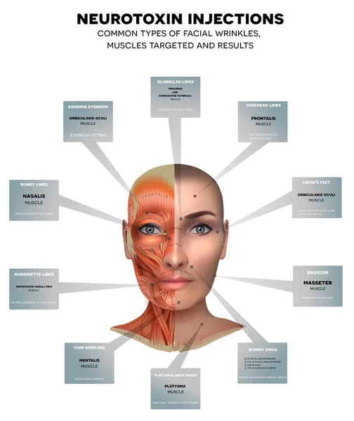 Inyecciones para arrugas faciales — Vector de stock