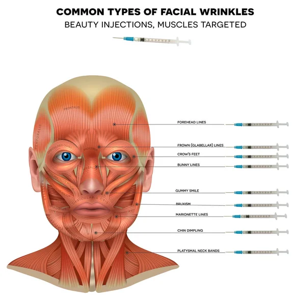 Tipos comunes de arrugas faciales — Vector de stock