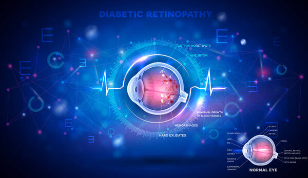Eye with Diabetic retinopathy, vision disorder and normal eye anatomy on an abstract blue scientific background, detailed info poster digital futuristic illustration
