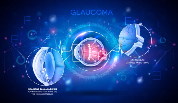 Glaukom Poruchy Vidění Abstraktní Modré Vědecké Pozadí Detailní Anatomie Digitální — Stockový vektor