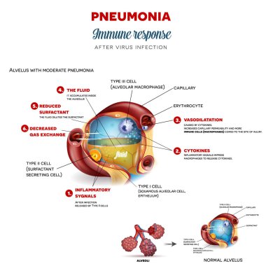 Pneumonia immune response step by step after virus infection, detailed alveolus anatomy illustration clipart