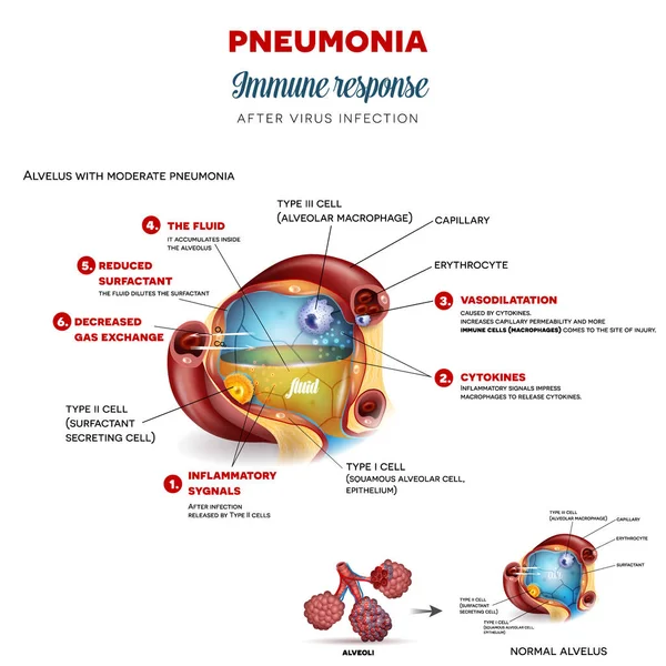 Pneumonia immune response step by step after virus infection, detailed