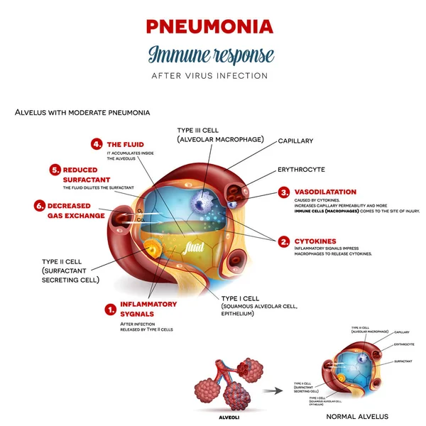 Pneumonia immune response step by step after virus infection, detailed alveolus anatomy illustration