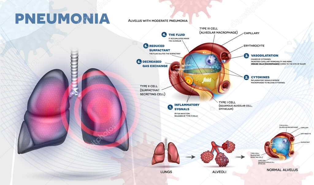 Pneumonia explained info poster, body immune response, human lungs and detailed alveolus anatomy illustration