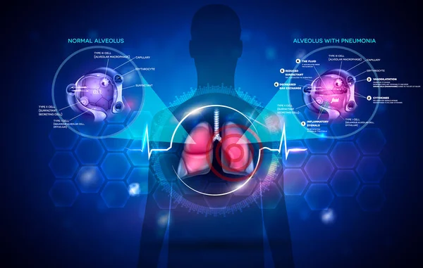 Pneumoni Förklaras Abstrakt Blå Bakgrund Info Affisch Kropp Immunsvar Mänskliga — Stock vektor