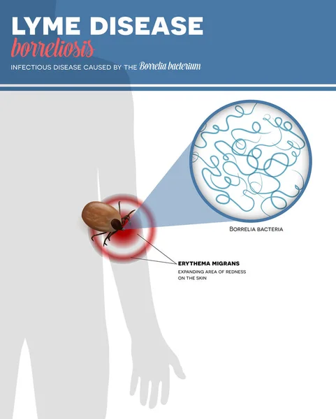 Kene Isırığından Kaynaklanan Lyme Borreliosis Enfeksiyonu Renkli Bilgi Posteri — Stok Vektör