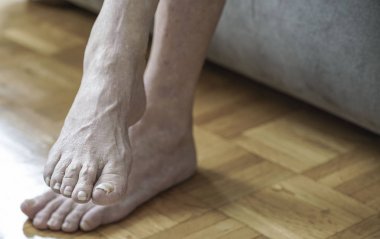 Mantar ve mantar nedeniyle ayakları ile artrit, closeup zarar çivi sonra kemoterapi