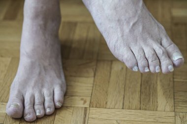 Mantar ve mantar nedeniyle ayakları ile artrit, closeup zarar çivi sonra kemoterapi
