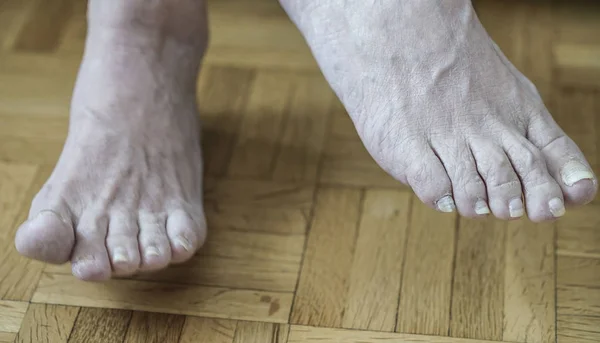 Închiderea Picioarelor Artrită Unghiile Deteriorate Din Cauza Ciupercii Piciorului Atletului — Fotografie, imagine de stoc