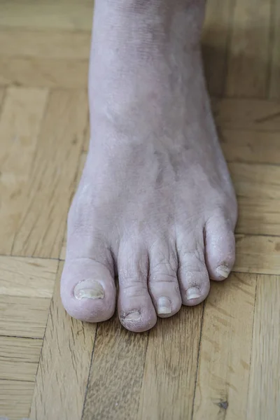 Închiderea Piciorului Artrită Unghiile Deteriorate Din Cauza Ciupercii Piciorului Atletului — Fotografie, imagine de stoc
