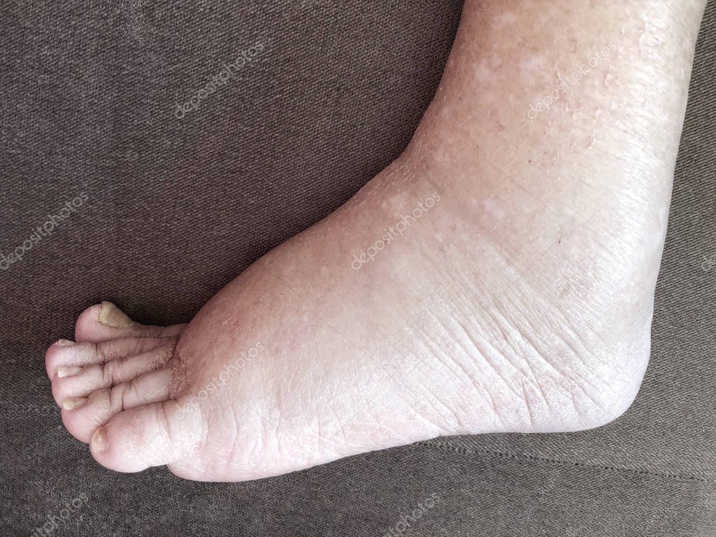 Closeup foot of diseased female patient who suffers from edema illness