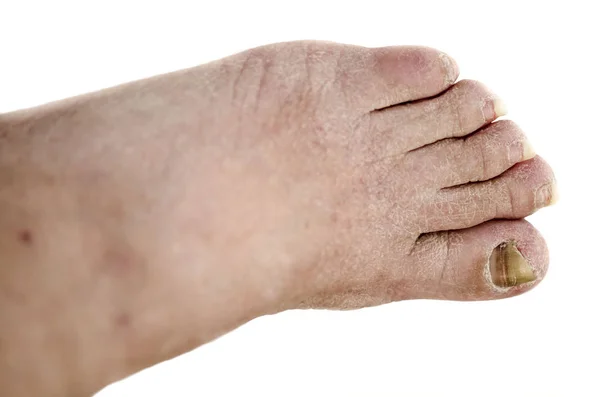 Pie con artritis, uñas dañadas debido a hongos y atleta Imagen De Stock
