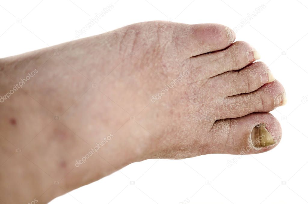 foot with arthritis, damaged nails because of fungus and athlete