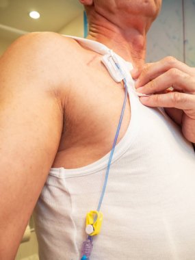 C için implante edilebilir bağlantı noktasına intravenöz sıvı enjeksiyon için tüp