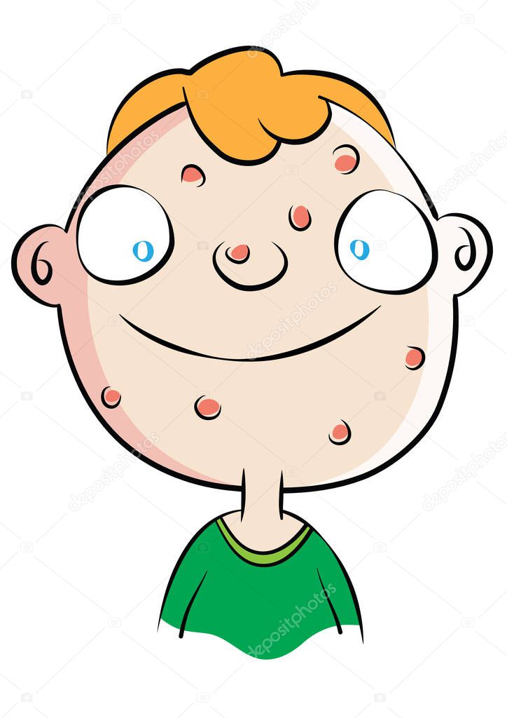 cute white boy with acne problem 