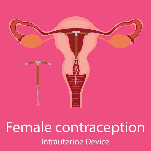 Anticoncepción Espiral intrauterina — Vector de stock