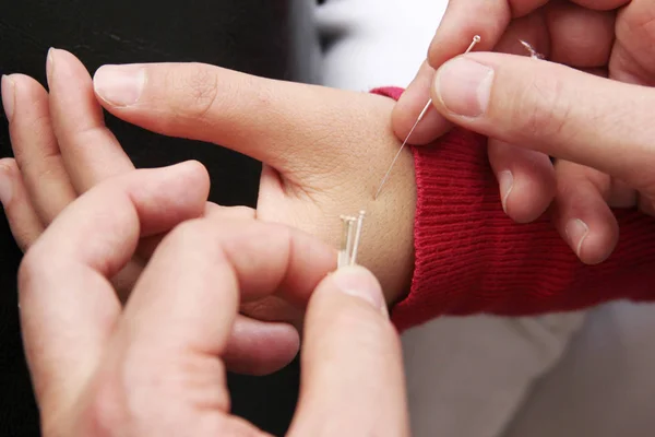 Mão realizando terapia de acupuntura — Fotografia de Stock