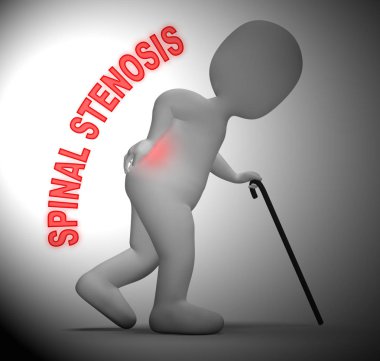 Spinal stenoz temsil eden omurga ağrısı 3d render