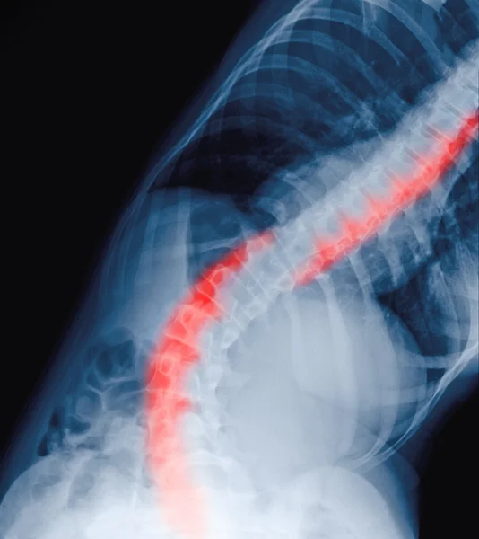 Сколиоз пленки рентген показывает изгиб позвоночника у пациента-подростка. Консе — стоковое фото