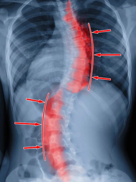 Skolios film röntgen spinal krökning. Behandlingskoncept — Stockfoto