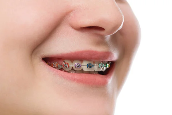 Closeup vícebarevné rovnátka na zuby. Krásné ženské úsměv por — Stock fotografie
