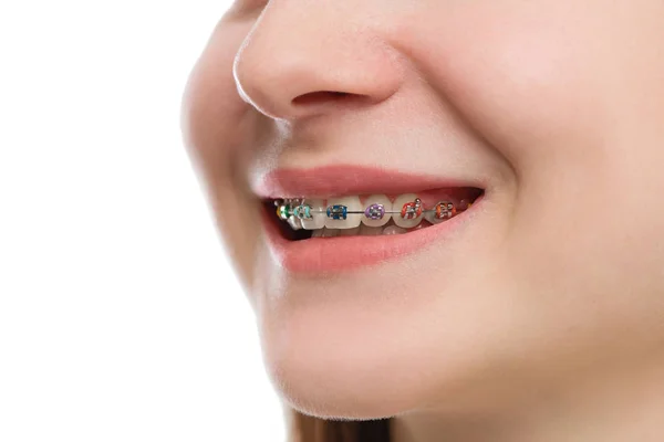 Frenos multicolores de primer plano en los dientes. Hermosa sonrisa femenina por — Foto de Stock