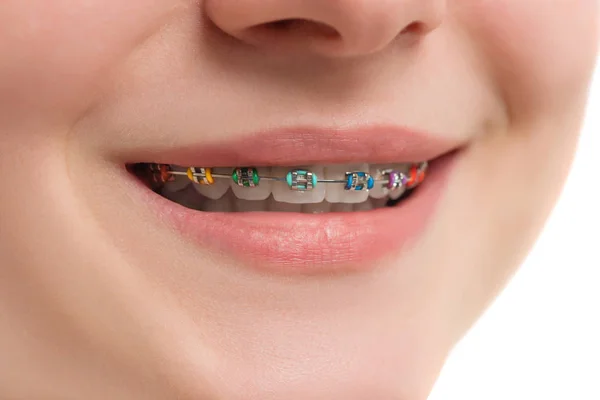 Frenos multicolores de primer plano en los dientes. Hermosa sonrisa femenina ingenio — Foto de Stock