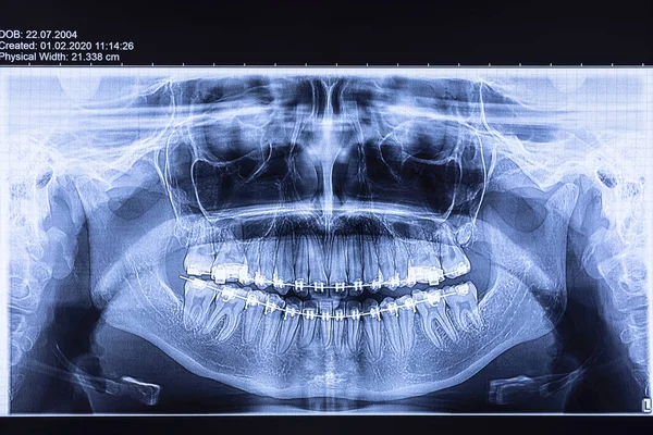 歯列X線ブレース付き 歯の矯正と歯科構造のための放射線学研究コンセプト — ストック写真