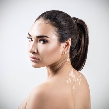 Vitiligo 'lu güzel bir kadının portresi.