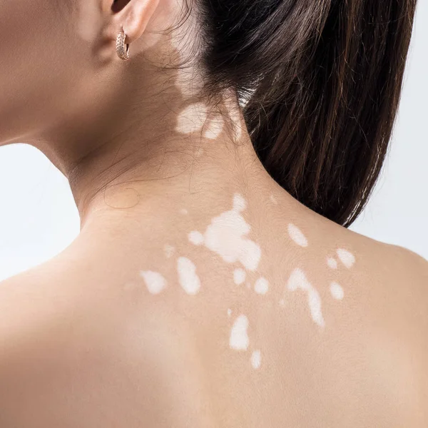 Vitiligo ile kadın sırtında arka görüş.