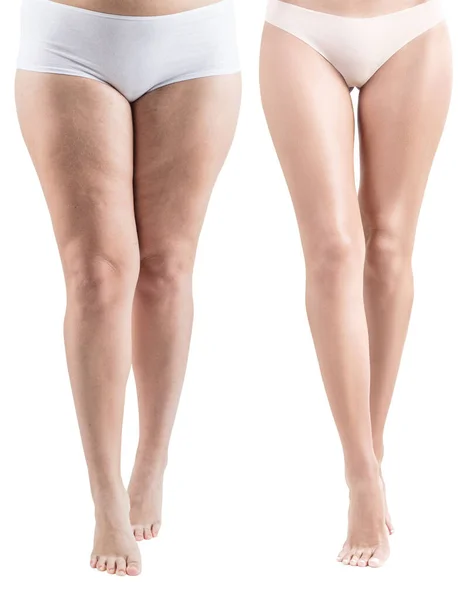 Frauenbeine vor und nach dem Abnehmen. — Stockfoto