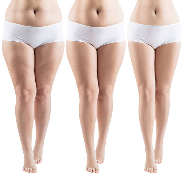 Woman legs before and after slimming.